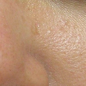 med spa patient model with dry skin