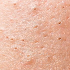 med spa patient model with blackheads