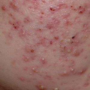 med spa patient model with teenage acne