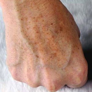 med spa patient model with aged hands