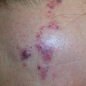 medspa patient model with port wine stain