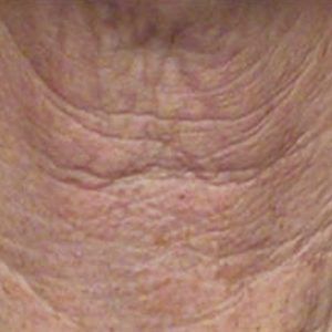 med spa patient model with crepey skin