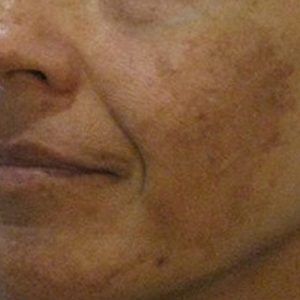 med spa patient model with hyperpigmentation