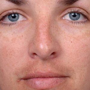 medspa patient model with melasma