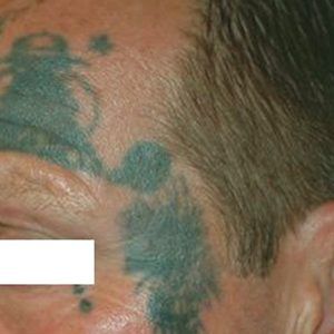 medspa patient model with facial tattoos
