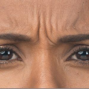 med spa patient model with frown lines