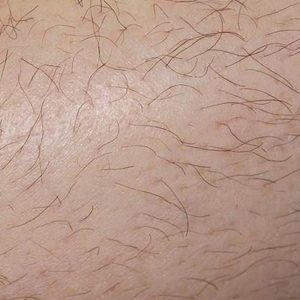 med spa patient model with unwanted body hair