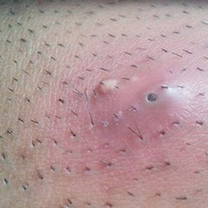 med spa patient model with ingrown hair