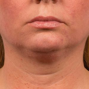 med spa patient model with jowls