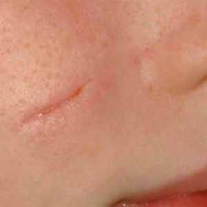 med spa patient model with cosmetic scars