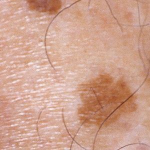 medical spa patient model with sun spots and age spots