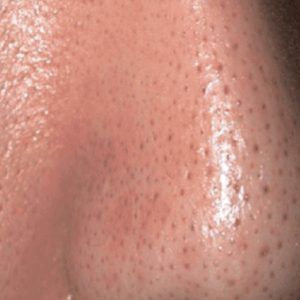 med spa patient model with enlarged pores