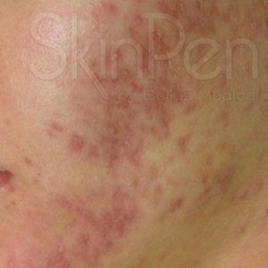 med spa patient model with cystic acne