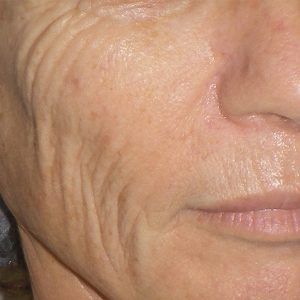med spa patient model with fine lines and wrinkles