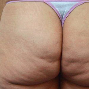 med spa patient model with cellulite