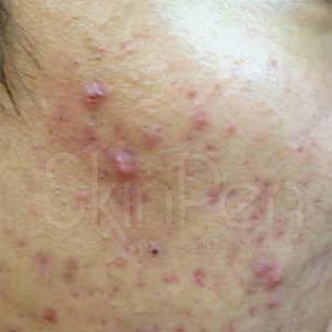 med spa patient model with acne