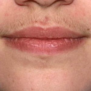 med spa patient model with unwanted facial hair