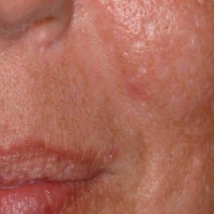 med spa patient model with uneven skin tone