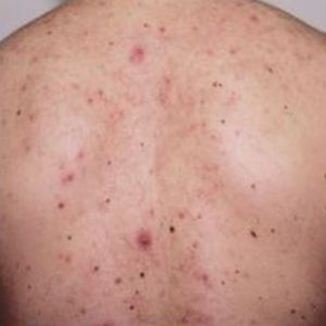 med spa patient model with back acne