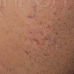 med spa patient model with acne scars