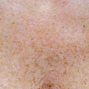 medspa patient model with sun damage