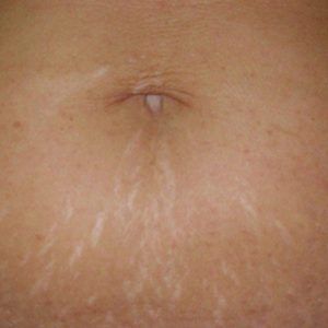 med spa patient model with stretch marks
