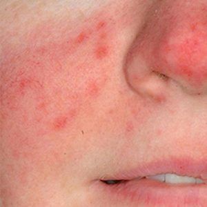 medspa patient model with rosacea