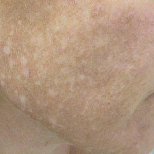 medspa patient model with hypopigmentation