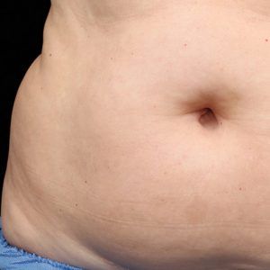 med spa patient model with stubborn fat